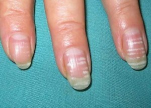 Manchas blancas en las uñas: causas y cómo se trata
